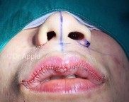 Intervenções corporais extremas  Redução labial 